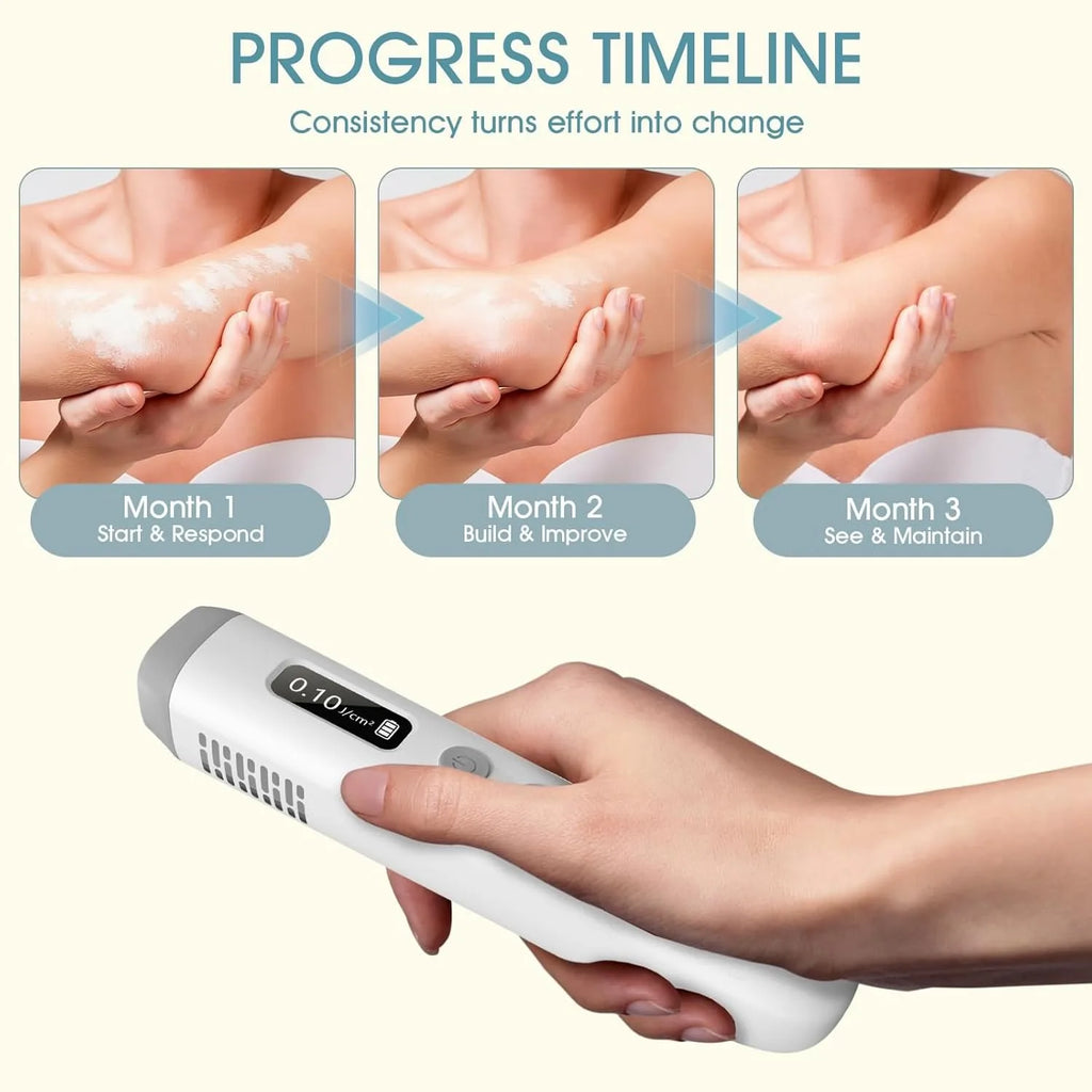 308nm UVB Handheld Phototherapy Lamp – Home UV Light Device UV Phototherapy Lamp Qst