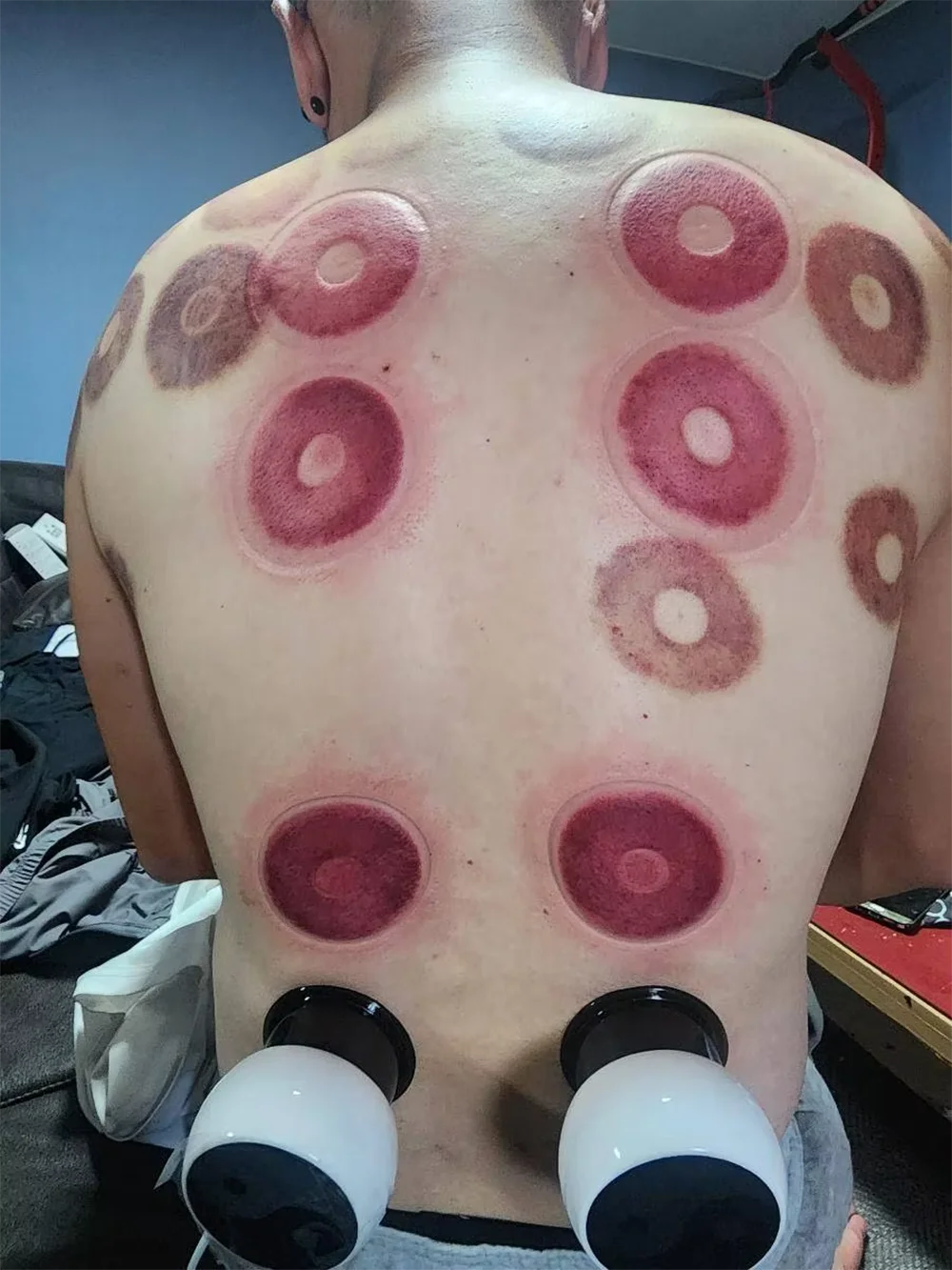 Vilnason Smart Electric Cupping Gua Sha Massager – LCD Display Electric Cupping Massager Qst