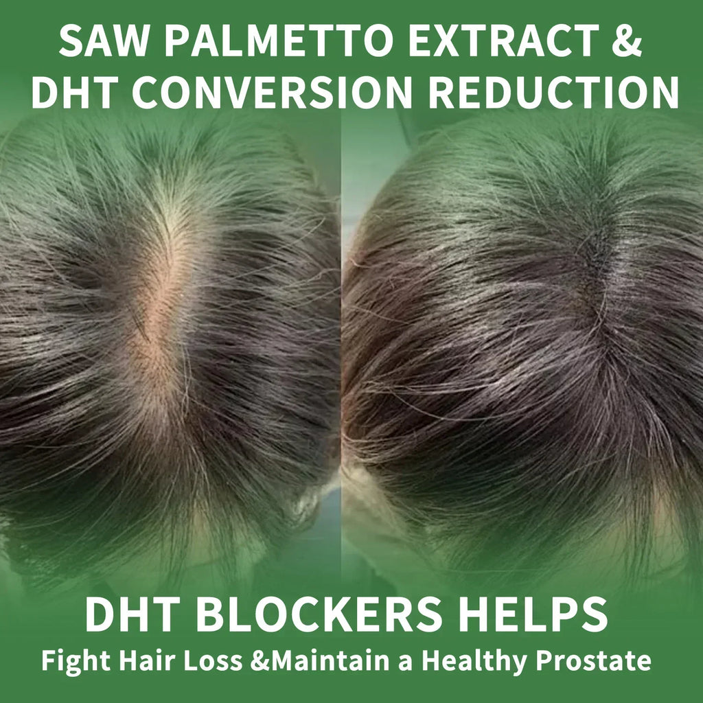Saw Palmetto Capsules – Prostate, Urinary & Hair Growth Support Herbal Supplement Qst