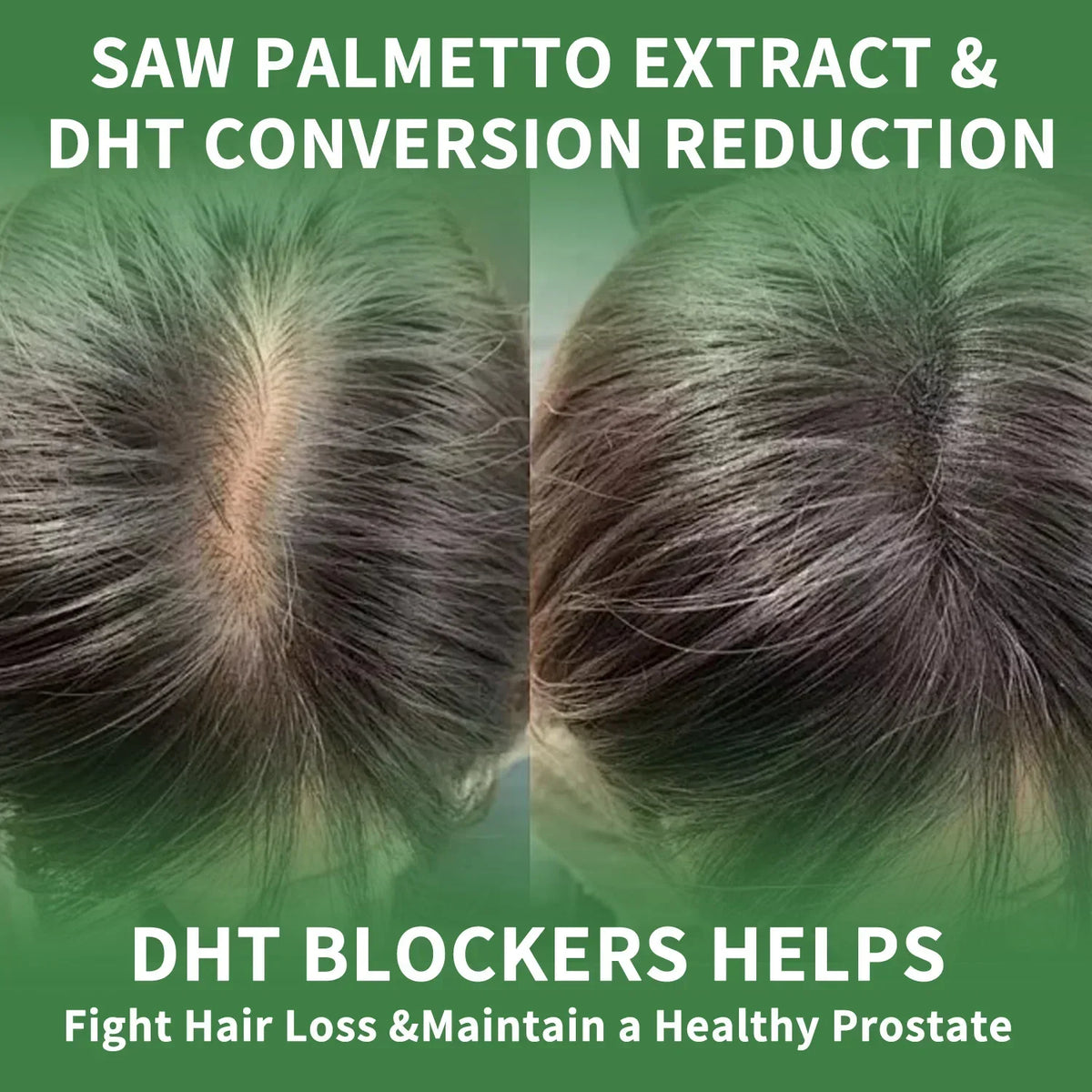 Saw Palmetto Capsules – Prostate, Urinary & Hair Growth Support Herbal Supplement Qst