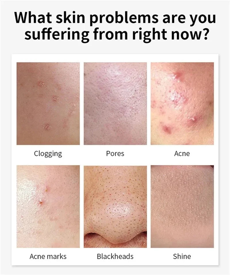 Salicylic Acid Face Cream – Oil Control & Pore-Clearing Moisturizer Salicylic Acid Face Cream Qme