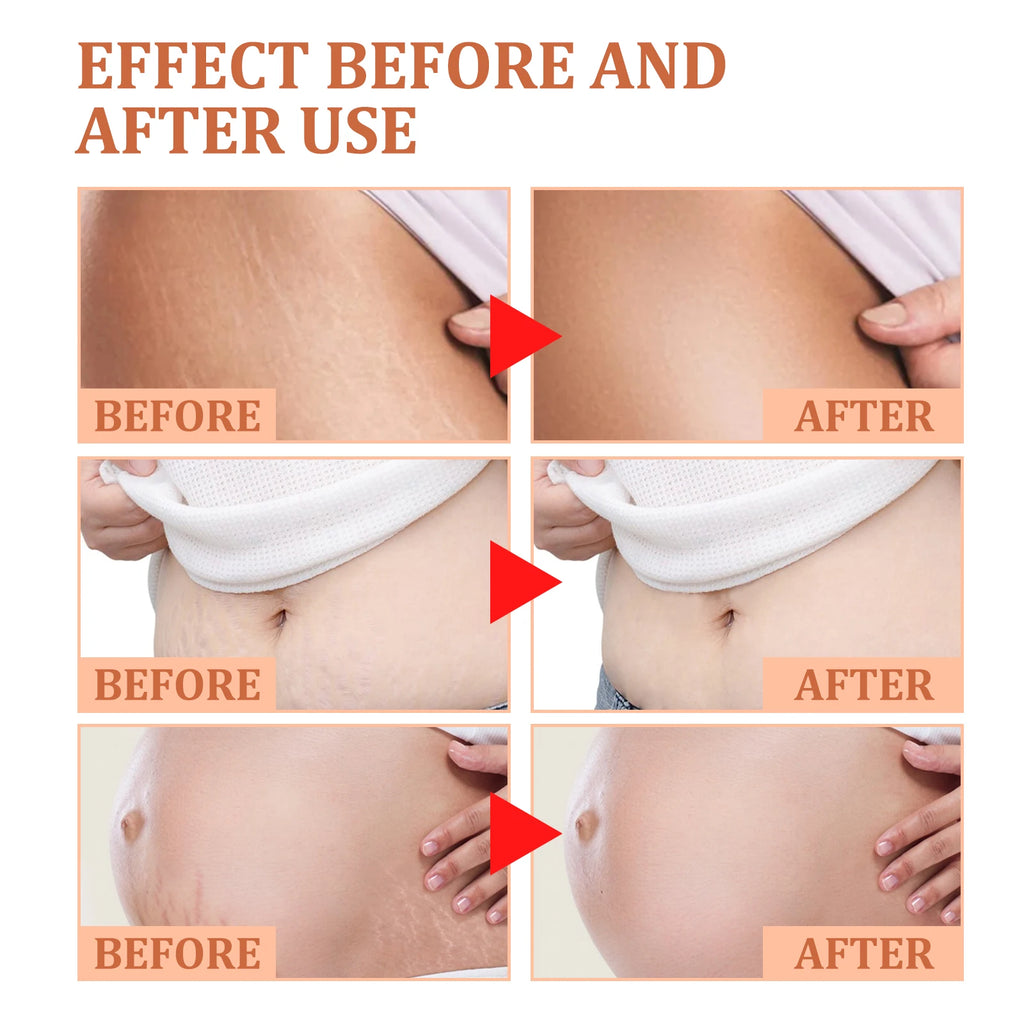 EELHOE Stretch Mark Cream – Firm, Smooth & Brighten Skin 45g Body Care Cream Qst