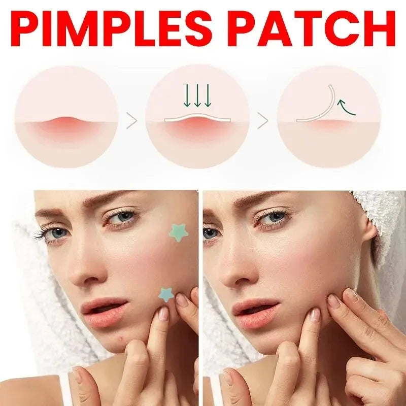 LGRAMER 200pcs Acne Pimple Patch – Blemish Cover Skin Care Acne Pimple Patch Qst