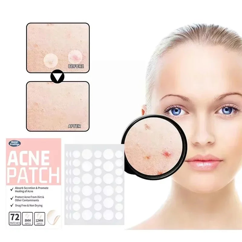 Invisible Hydrocolloid Acne Patches 72/144pcs – Waterproof Acne Patch Qst