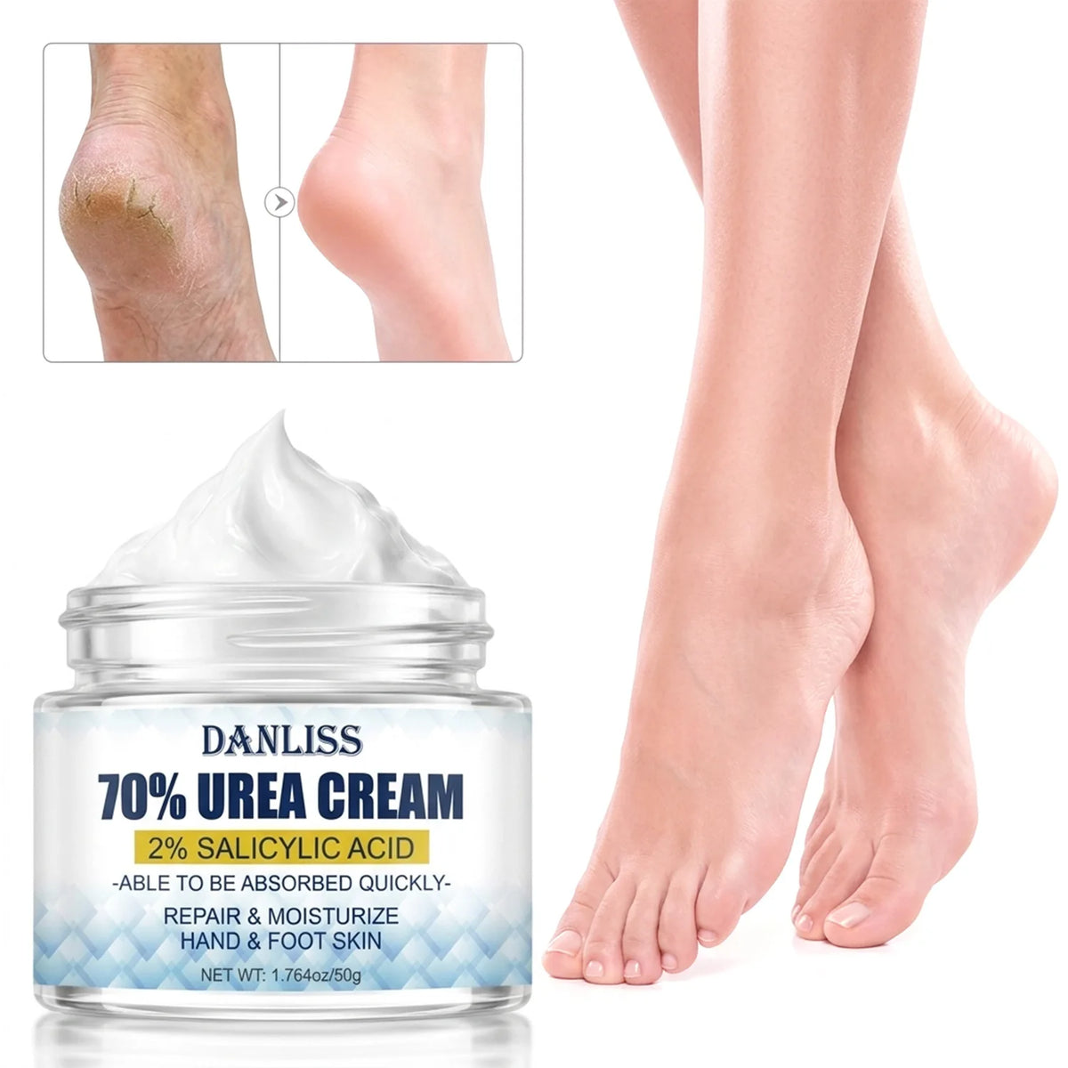 Lanemay 70% Urea Cream 2% Salicylic Acid – Feet & Hands 50g Foot & Hand Cream Qst