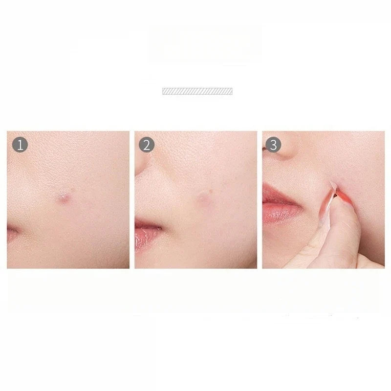Hydrocolloid Acne Patches – Waterproof Round Blemish Dots Hydrocolloid Acne Patches Qme