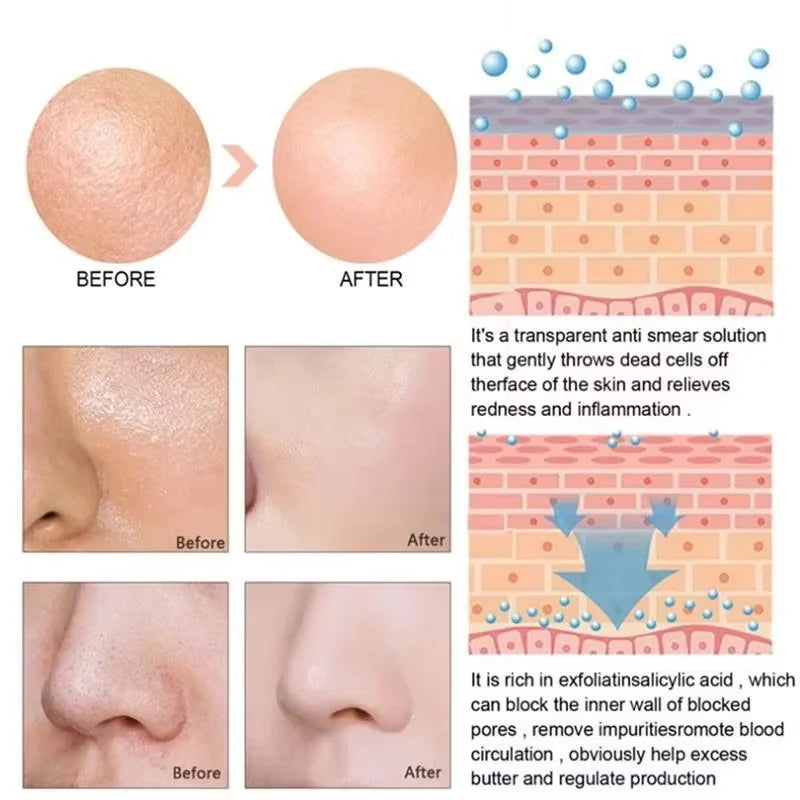 Qme Pore Minimizing Face Serum – Oil Control & Blackhead Serum Pore Refining Serum Qme