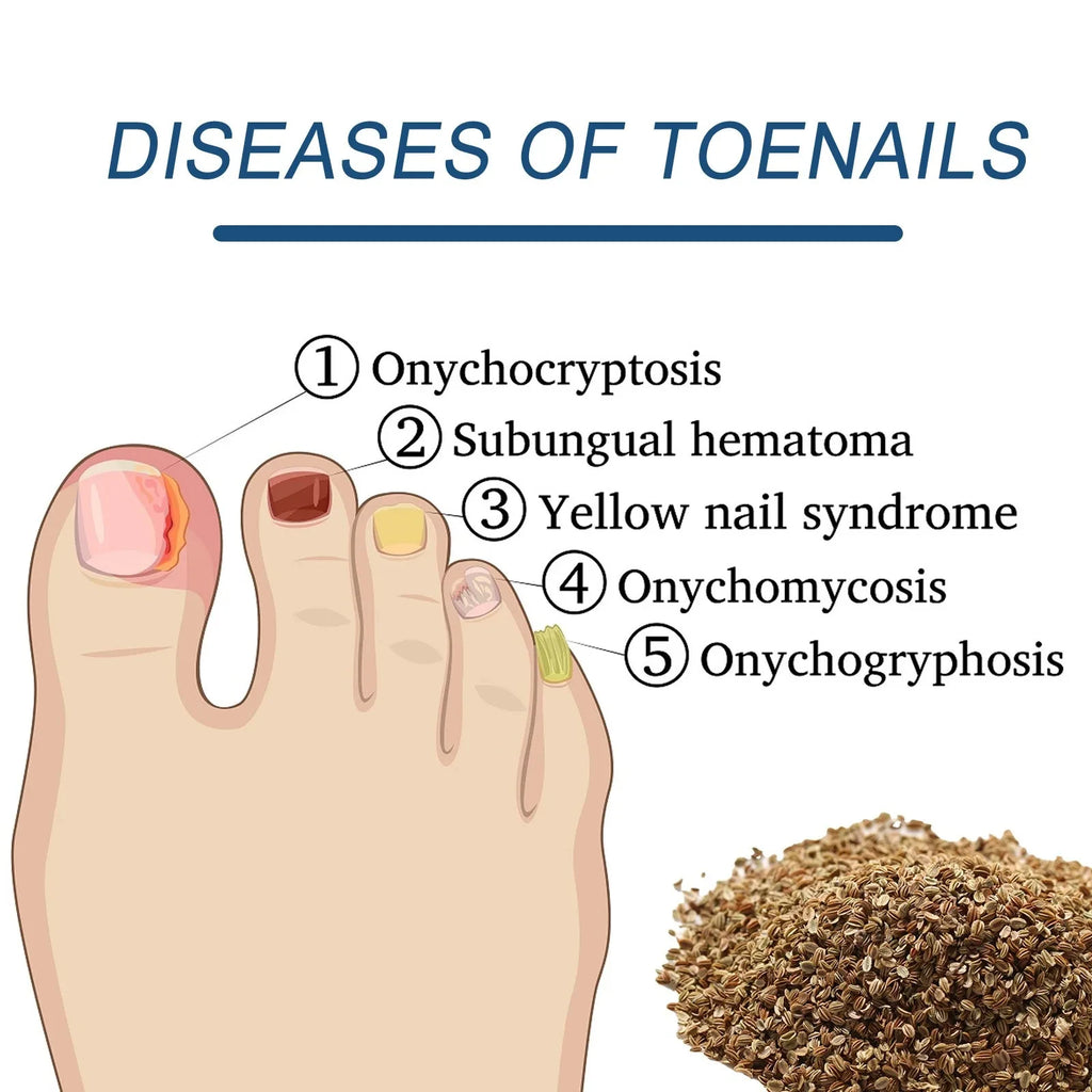 Toenail Correction Patch – Ingrown Nail & Nail Care Bandage Toenail Correction Patch Qst