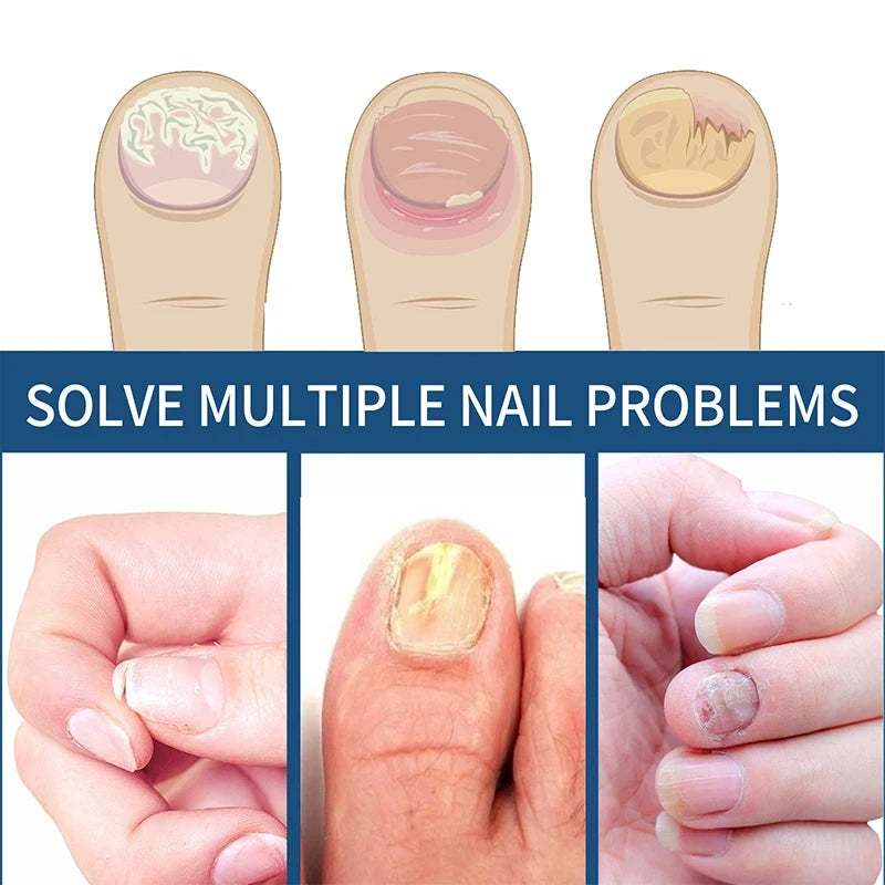 Toenail Correction Patch – Ingrown Nail & Nail Care Bandage Toenail Correction Patch Qst