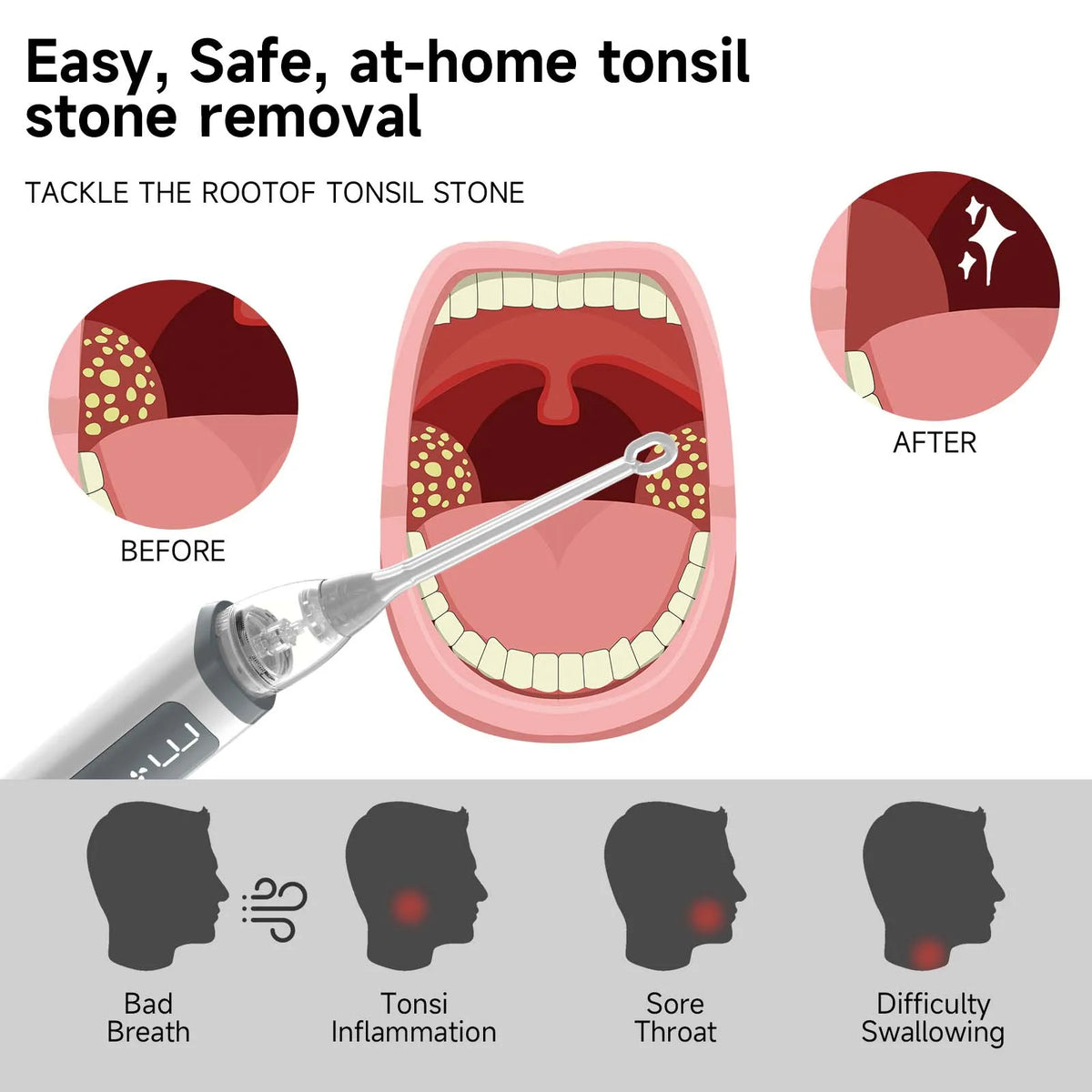 Electric Tonsil Stone Remover – LED, 8 Suction Modes, Oral Kit Oral Care Device Qst