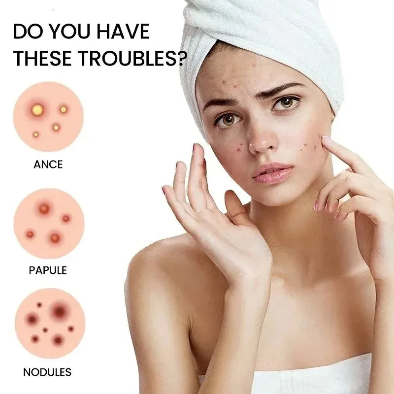 200pcs Star Acne Pimple Patches – Colorful Breathable Blemish Dots Acne Pimple Patch Qst