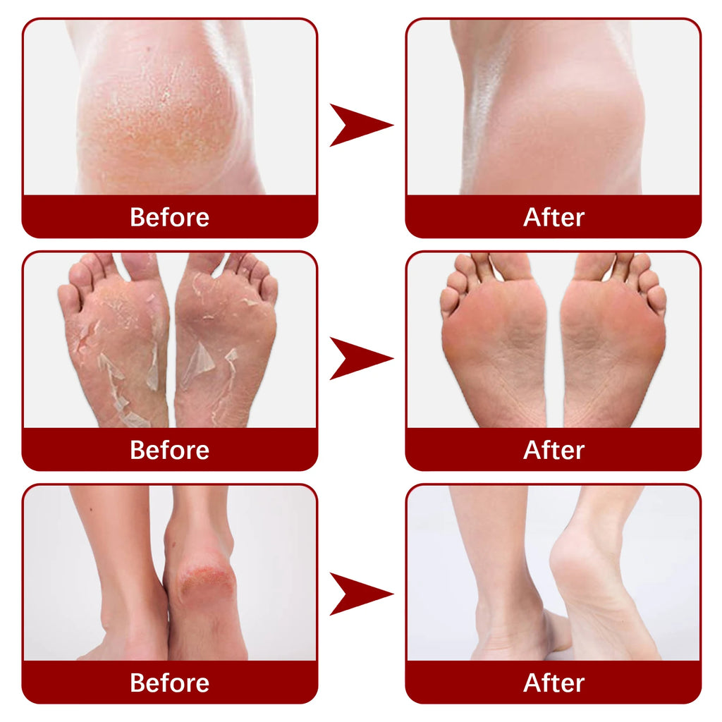 AHA Exfoliating Foot Peel Mask Booties – 5 Pairs Foot Peel Mask Qst