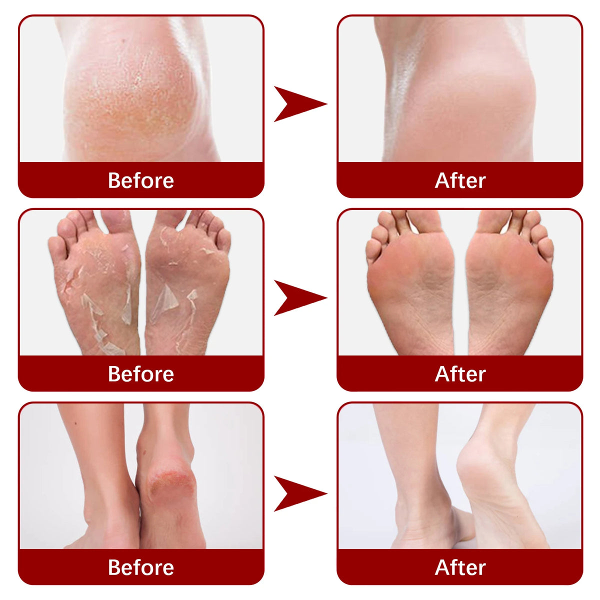 AHA Exfoliating Foot Peel Mask Booties – 5 Pairs Foot Peel Mask Qst
