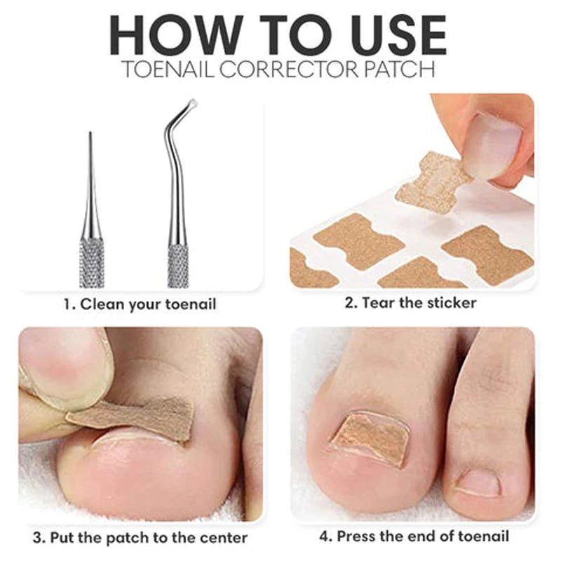 Toenail Correction Strips – Waterproof Pedicure Tool 10/100 Pcs Toenail Correction Strips Qst