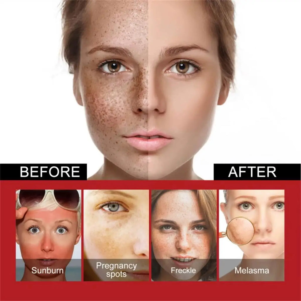 Brightening Dark Spot & Freckle Face Cream – Niacinamide Brightening Face Cream Qme
