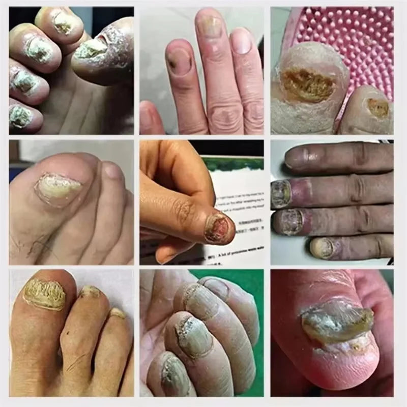 Nail Repair Serum – Toe & Foot Nail Restoration Liquid | Qme Nail Repair Serum Qme