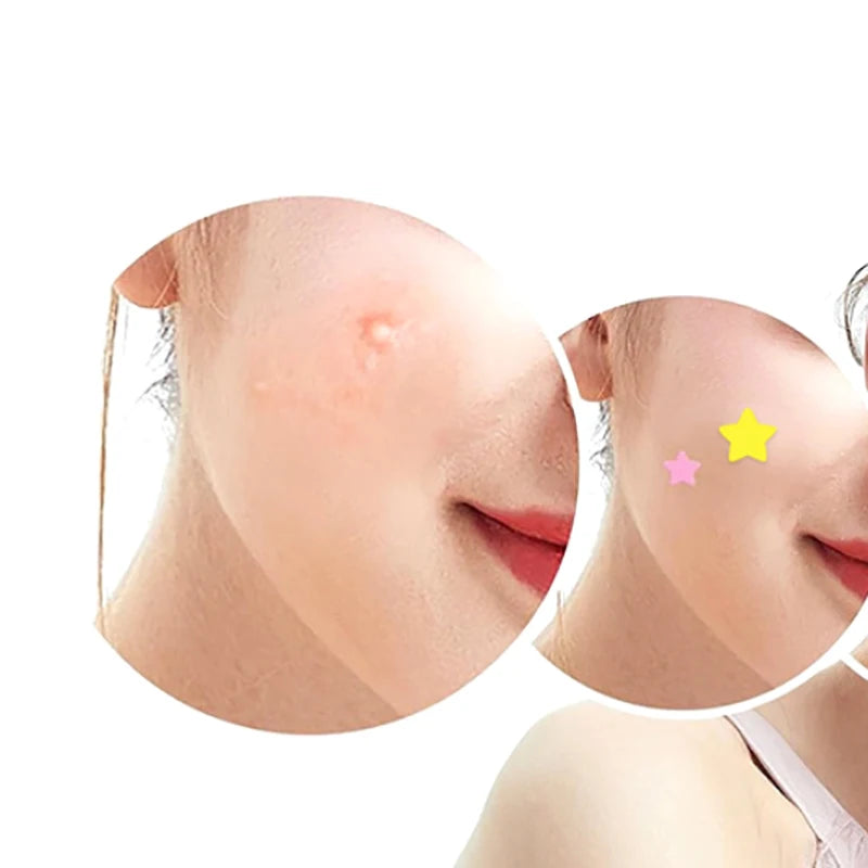51PCS Hydrocolloid Acne Patches – Invisible Blemish Cover Dots Acne Patch Qst
