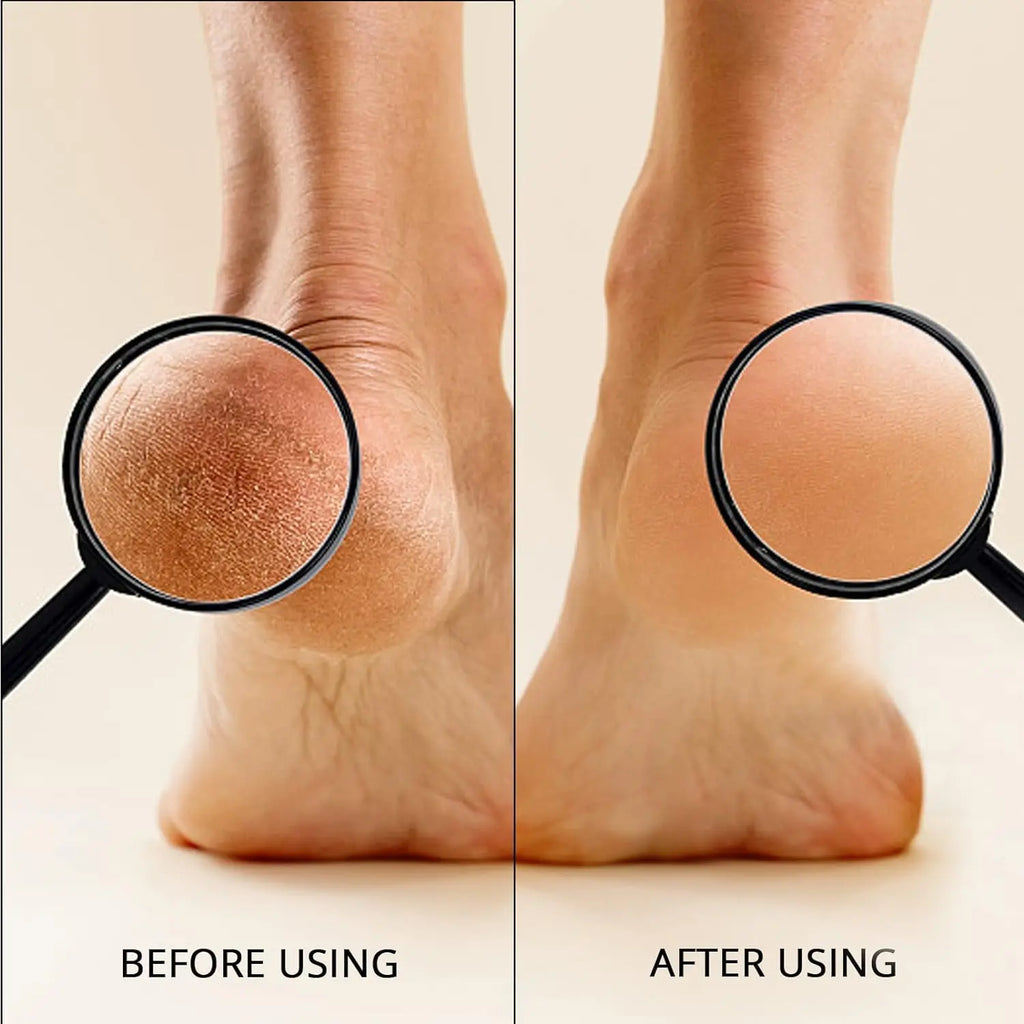 Natural Pumice Stone Foot Callus Remover – Heel Scrubber Foot Callus Remover Qst