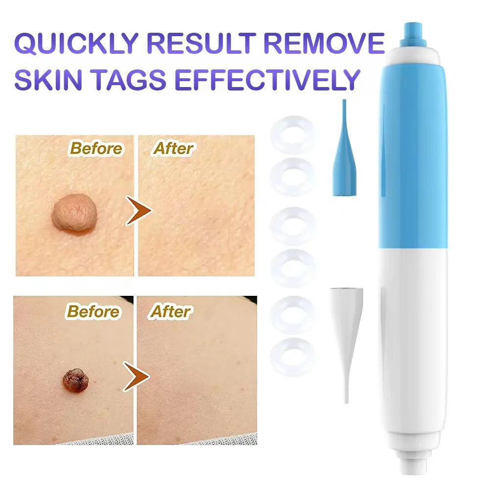 2-in-1 Skin Tag Removal Kit – Band Device for Face & Body Skin Tag Removal Kit Qst