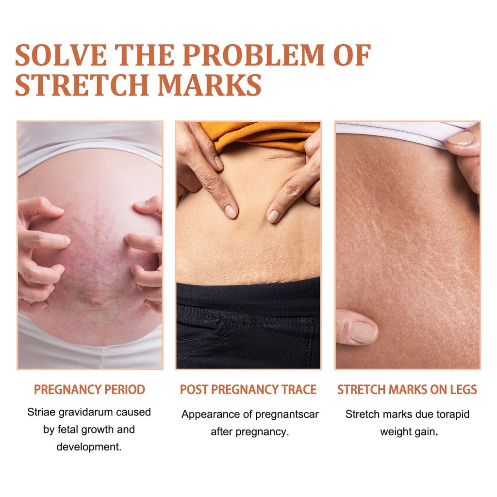 EELHOE Stretch Mark Cream – Firm, Smooth & Brighten Skin 45g Body Care Cream Qst