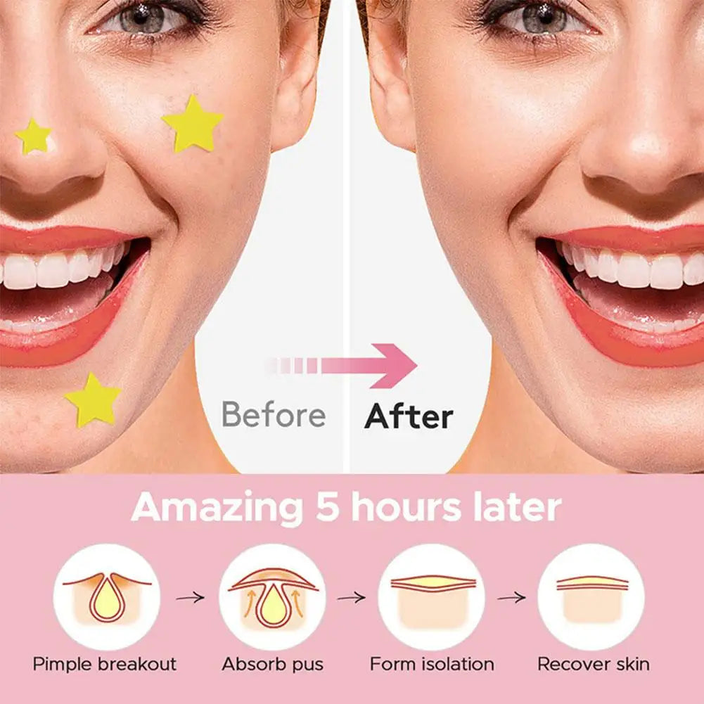 Star Hydrocolloid Acne Patch – Gentle Blemish Stickers Hydrocolloid Acne Patch Qme
