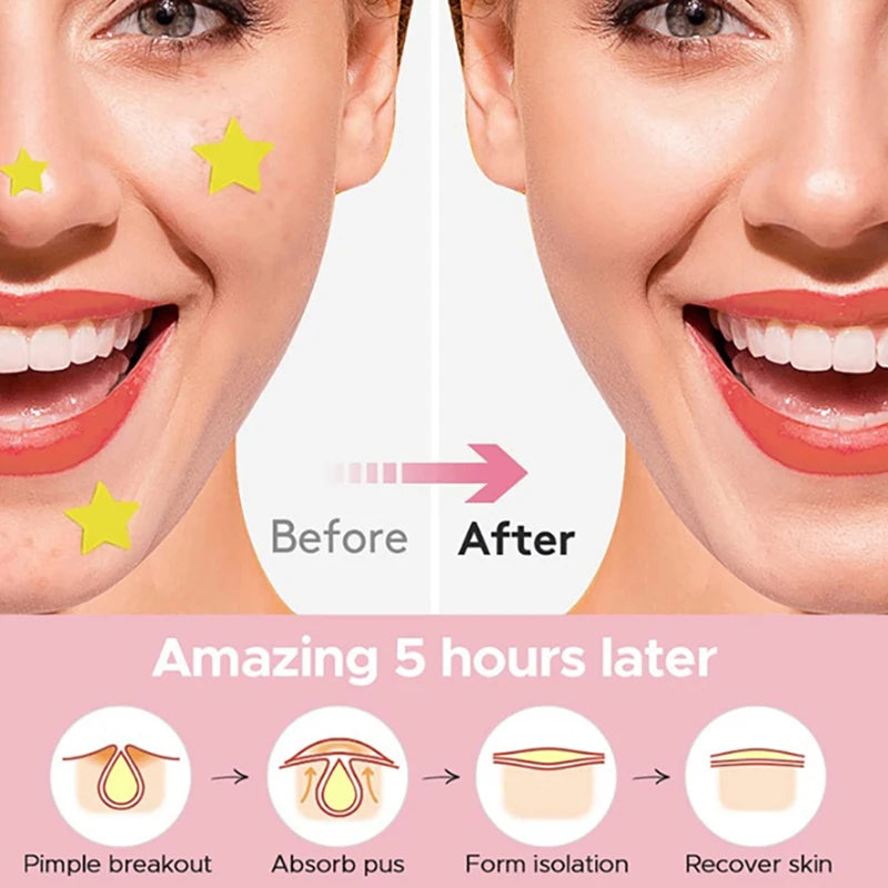 360pcs Invisible Acne Pimple Patches – Heart & Star Shapes Acne Pimple Patch Qst