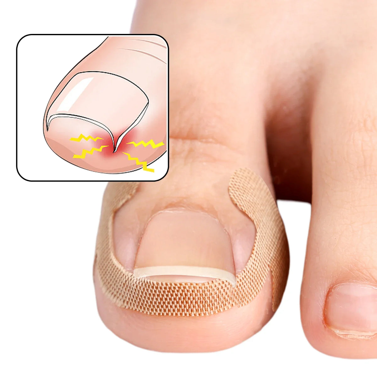 Waterproof Toenail Correction Strips | Lasting Adhesion Nail Correction Strips Qme