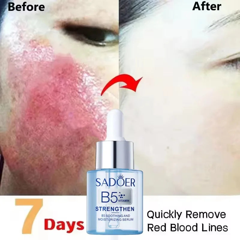 Facial Redness Repair Serum – Sensitive & Dry Skin Serum Facial Serum Qme