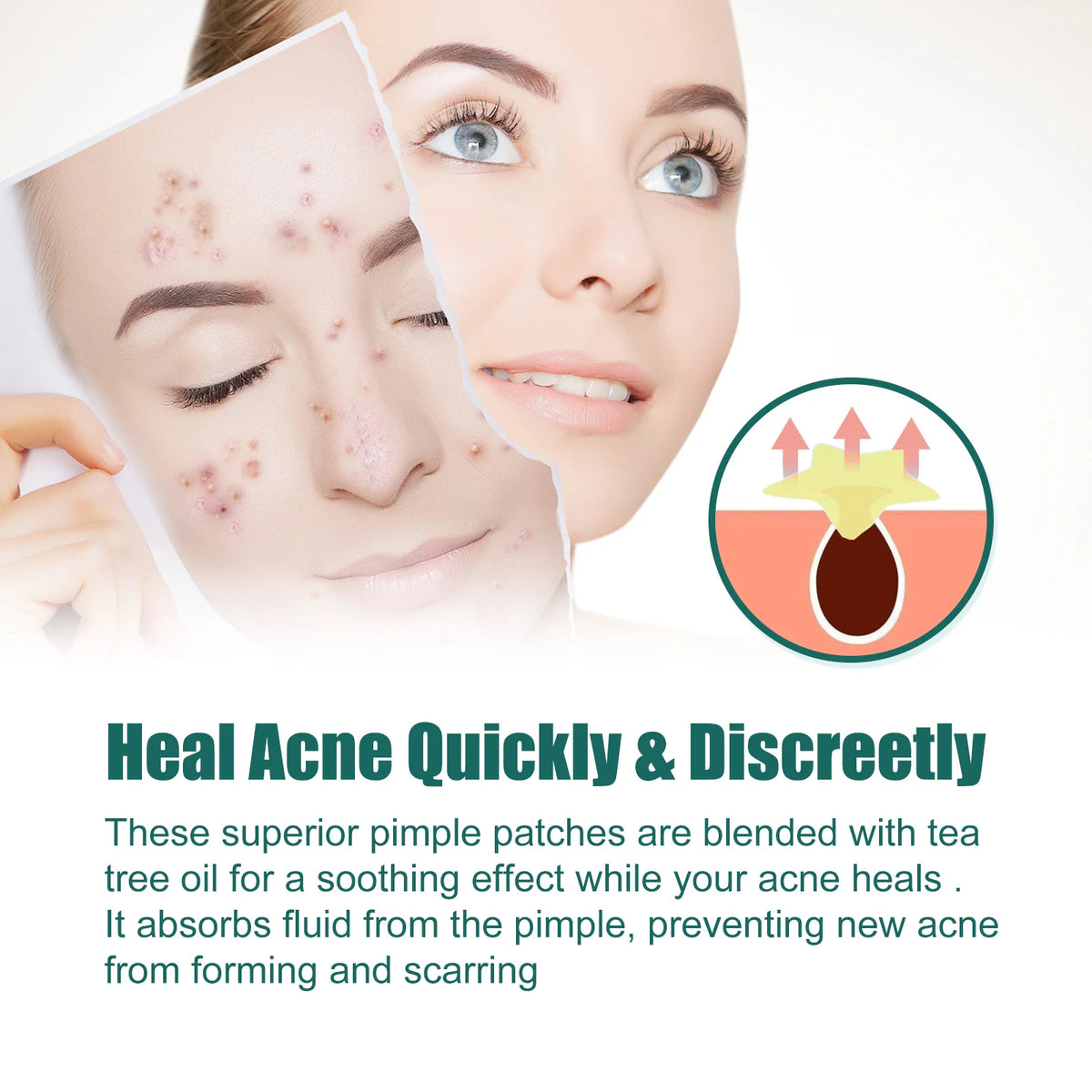 Star-Shaped Acne Pimple Patch – Gentle Blemish Care | Eelhoe Acne Pimple Patch Qst