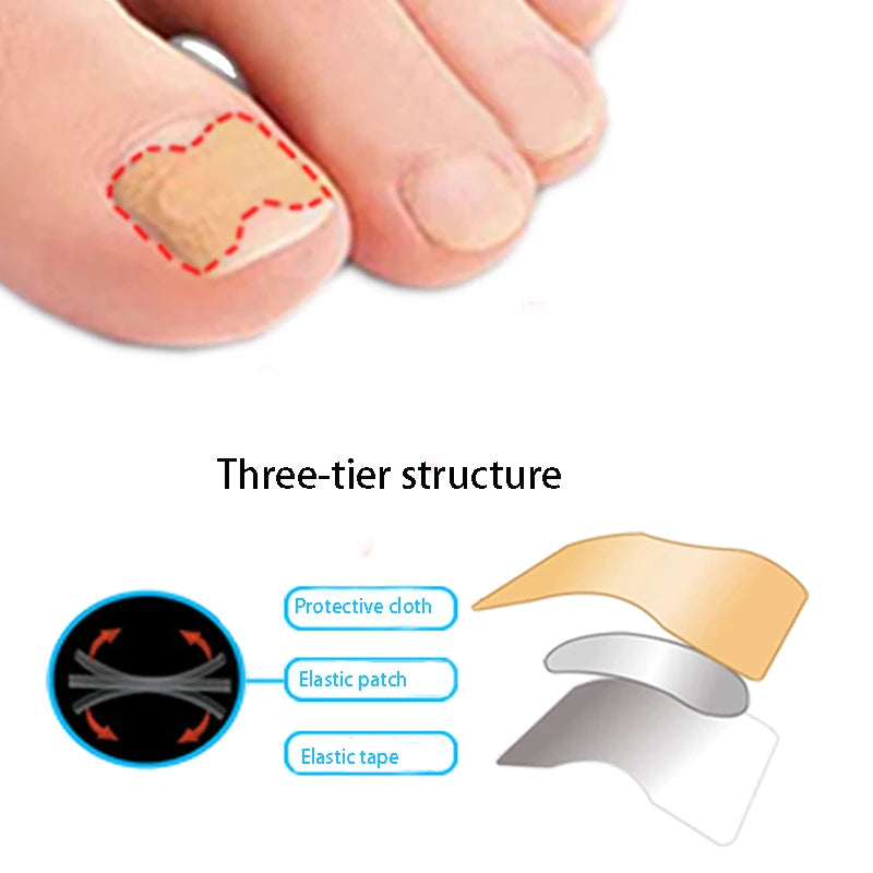 Toenail Correction Strips – Waterproof Pedicure Tool 10/100 Pcs Toenail Correction Strips Qst