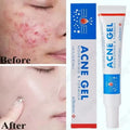 Salicylic Acid Face Cream – Oil Control & Pore-Clearing Moisturizer Salicylic Acid Face Cream Qme 1pc