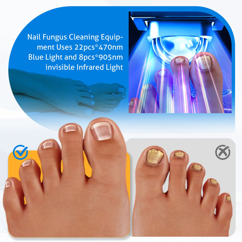 KTS Wireless Nail Laser Device – 30 Beads 470nm & 905nm Nail Laser Device Qst