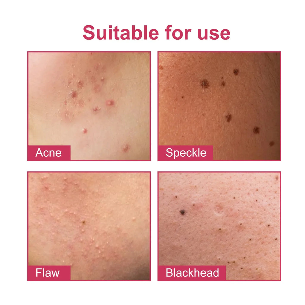 Star Pimple Patches – Colorful Invisible Skin Care Stickers 144pc Pimple Patch Stickers Qme