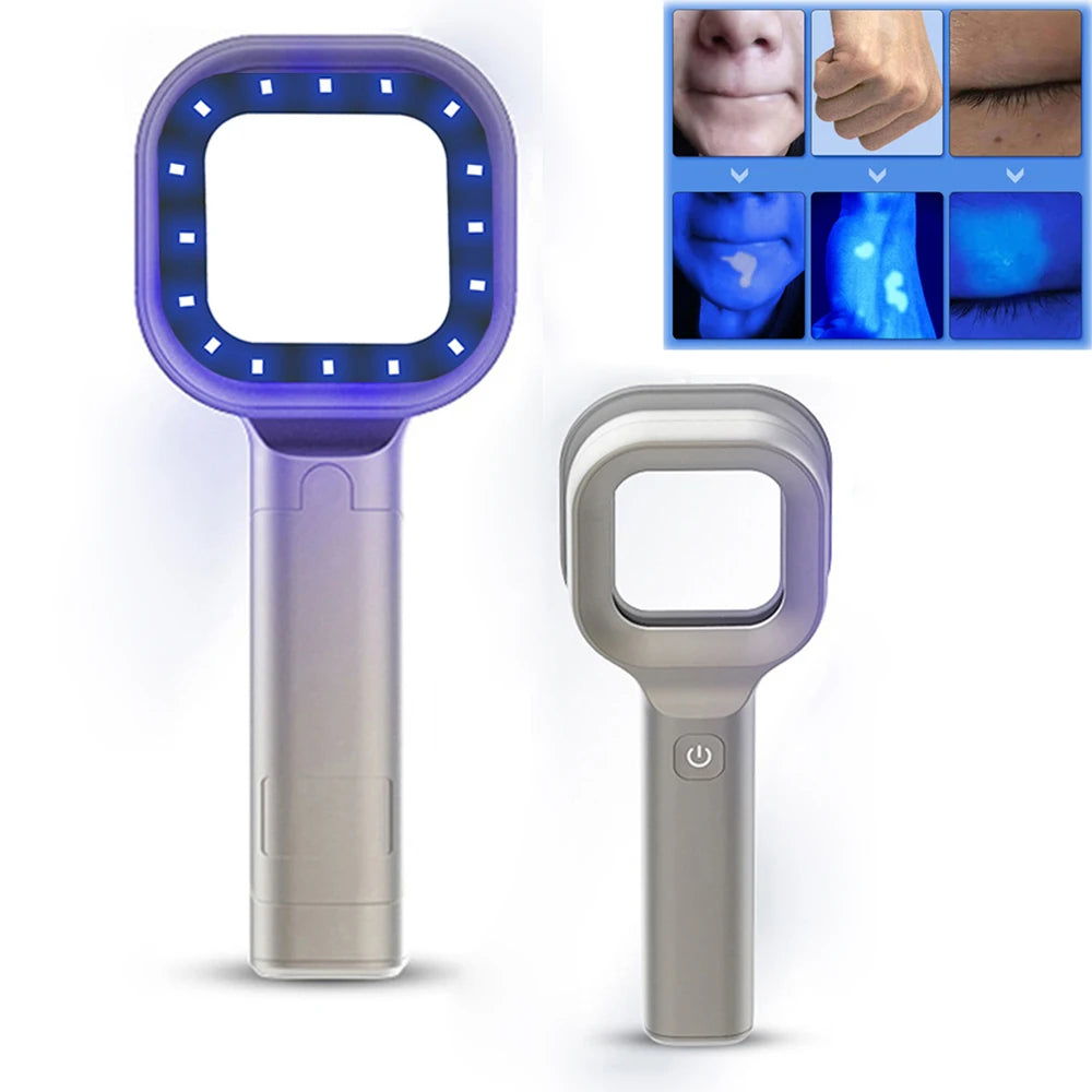 Wood's Lamp UV Skin Analyzer – Portable 365nm Beauty Tool UV Skin Analyzer Qst