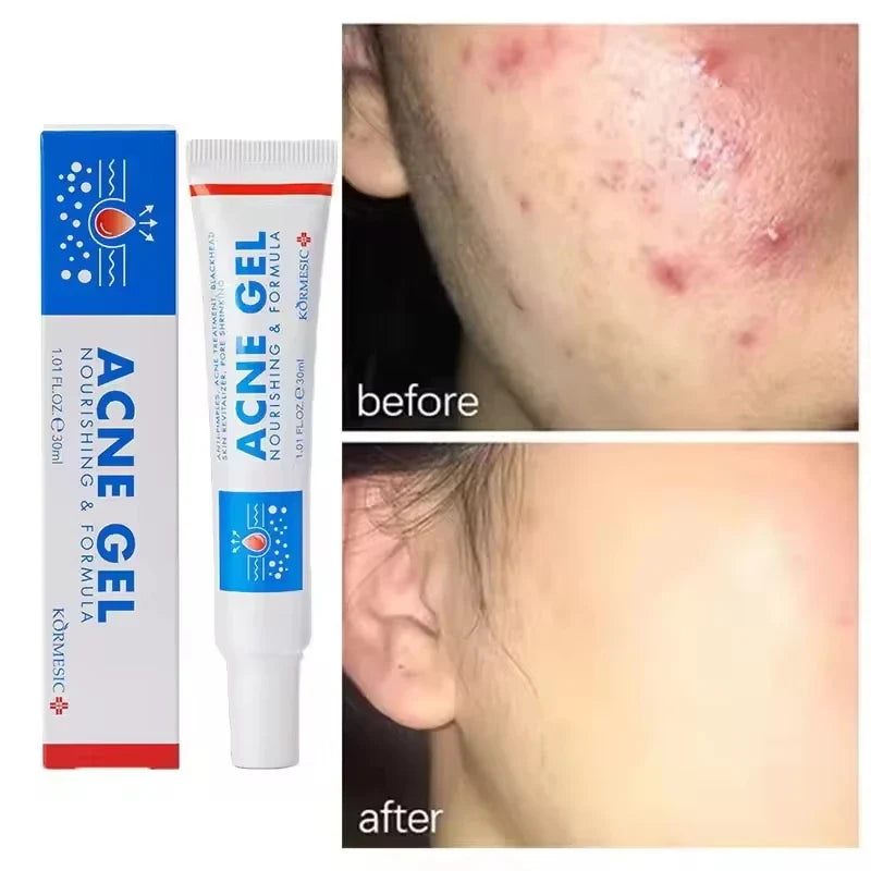 Salicylic Acid Face Cream – Oil Control & Pore-Clearing Moisturizer Salicylic Acid Face Cream Qme