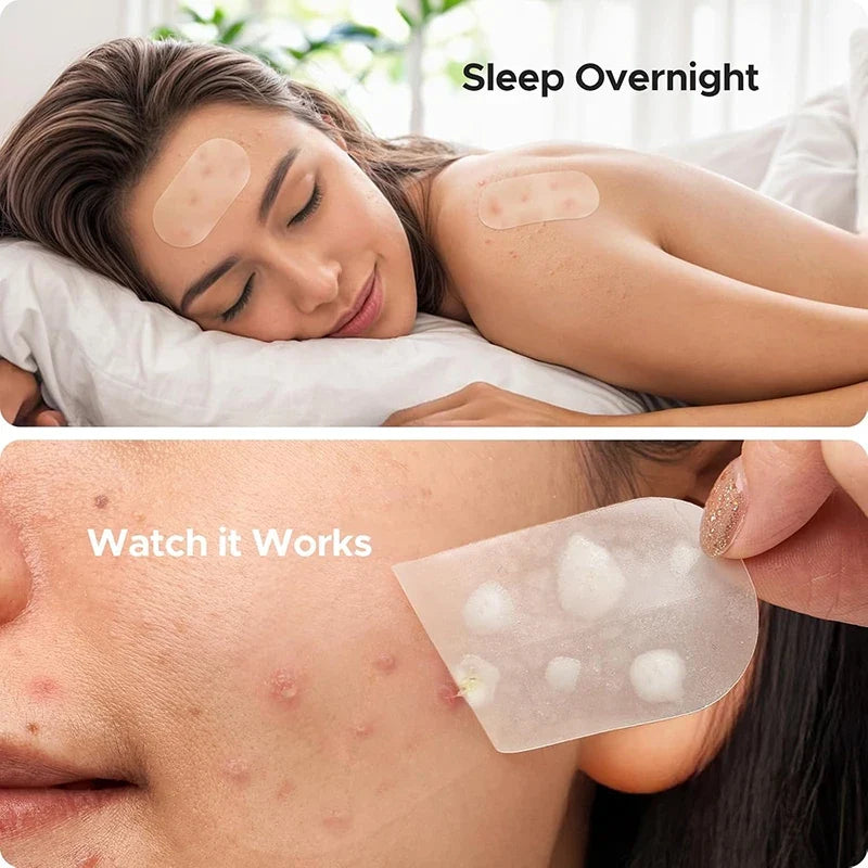 Invisible Blemish Spot Patches – 116 pcs Concealing & Repair Blemish Spot Patches Qme