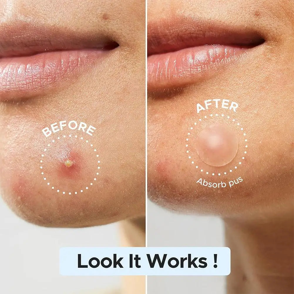 Invisible Acne Patches – Shaped Pimple Cover & Oil Control Acne Patch Qme
