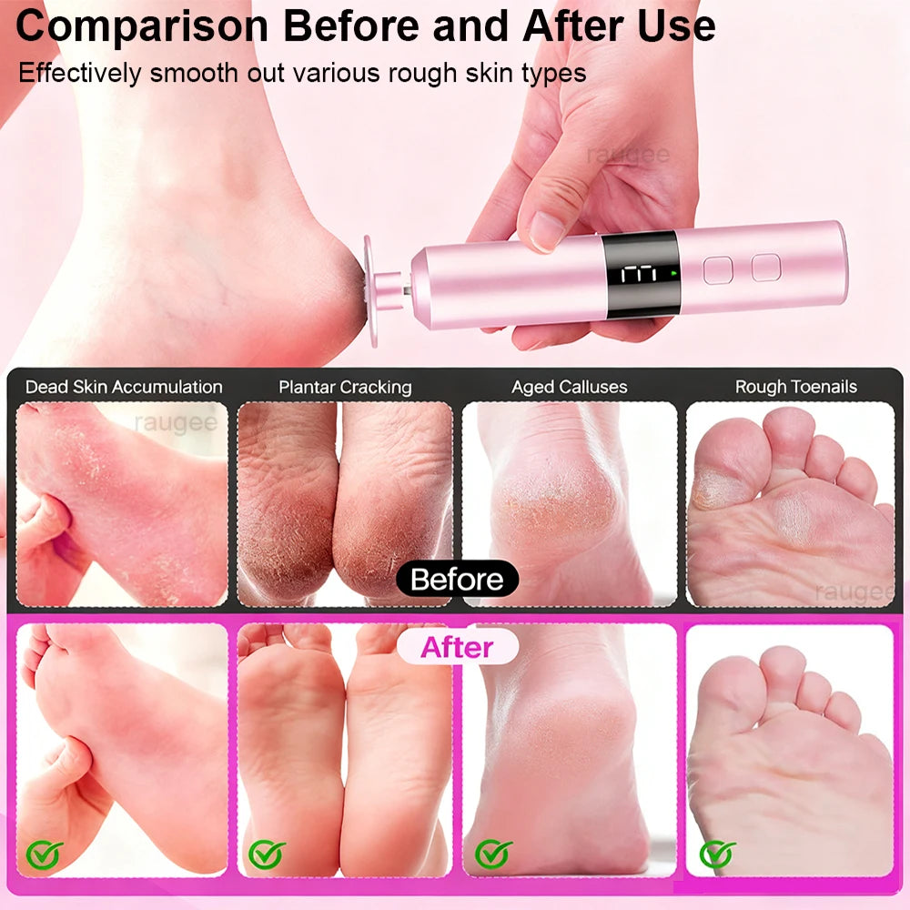 Electric Foot Callus Remover Rechargeable – bcomfy Feet File Electric Callus Remover Qst