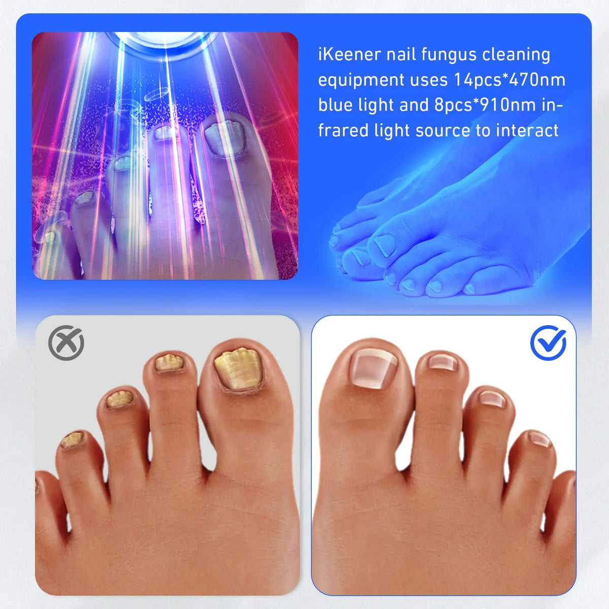 Wireless Nail LED Light Therapy Device – 910nm & 470nm, 22 LEDs Nail Light Therapy Device Qst