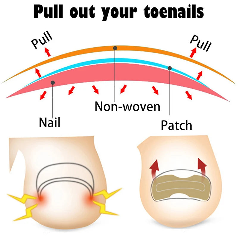 Toenail Correction Strips – Waterproof Pedicure Tool 10/100 Pcs Toenail Correction Strips Qst