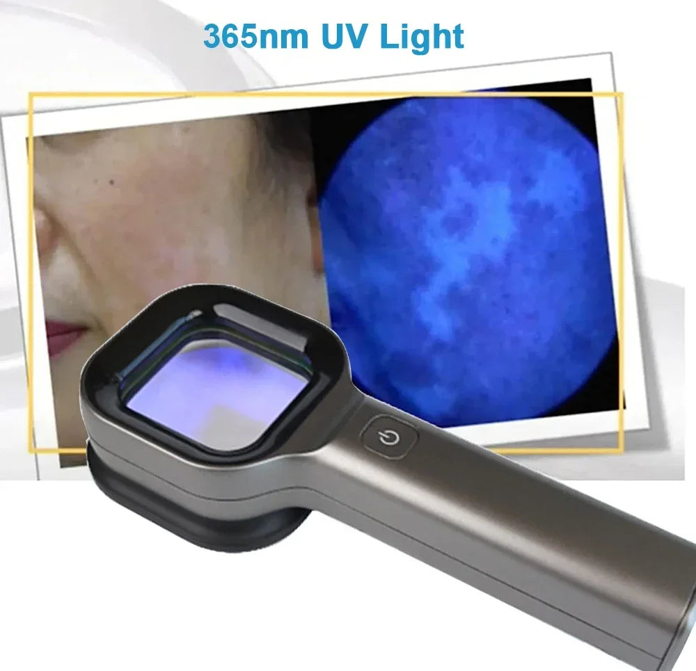 Wood's Lamp UV Skin Analyzer – Portable 365nm Beauty Tool UV Skin Analyzer Qst