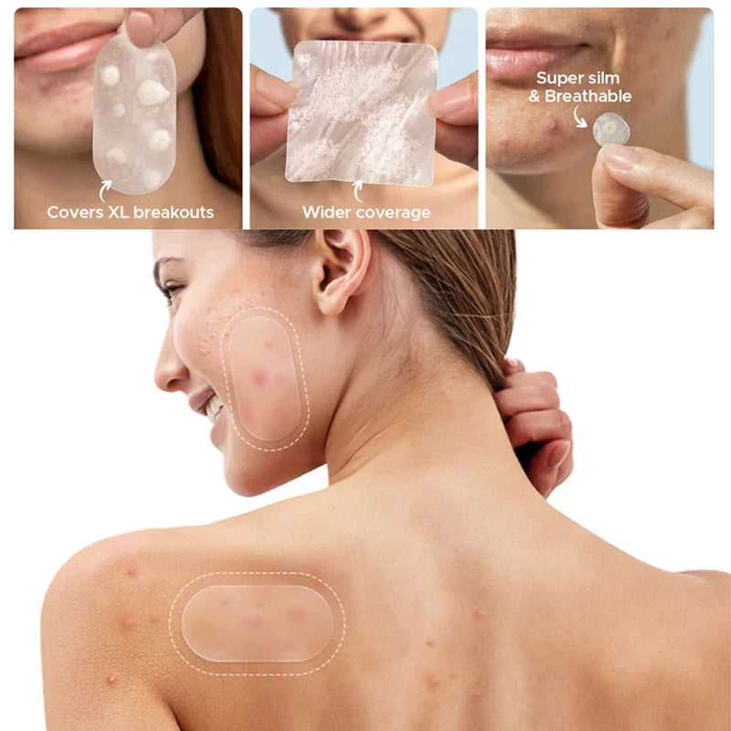 Invisible Blemish Spot Patches – 116 pcs Concealing & Repair Blemish Spot Patches Qme