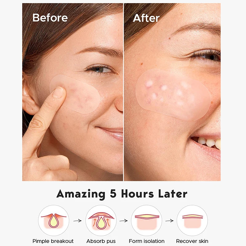 40-Piece Invisible Blemish Patches – Spot Concealer Stickers Blemish Spot Patches Qst