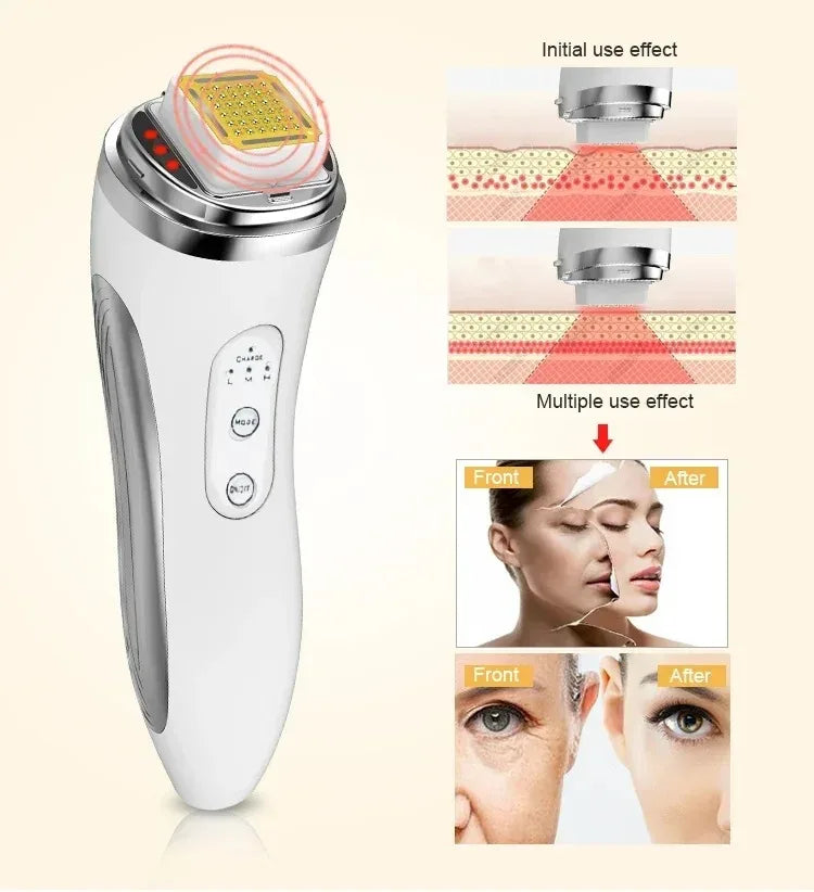 Vilnason Dot Matrix RF Facial Lifting & Skin Tightening Device Facial Lifting Device Qst