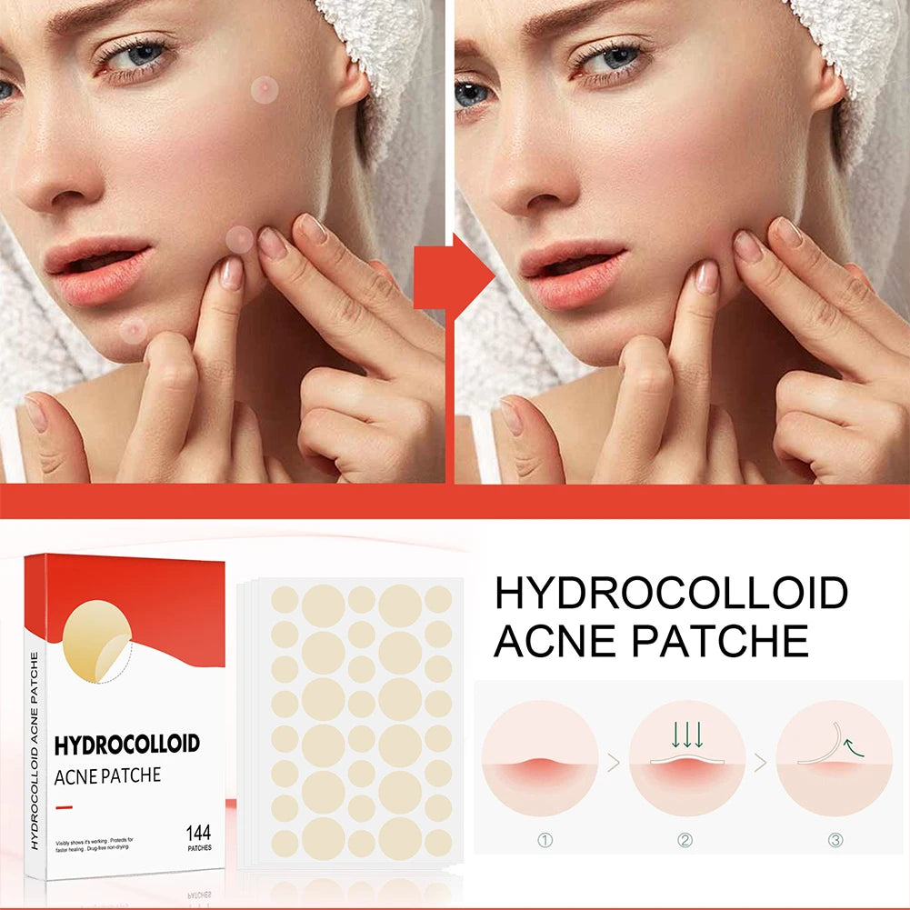 144pcs Hydrocolloid Acne Pimple Patches – 2 Sizes, Invisible Acne Spot Patches Qst