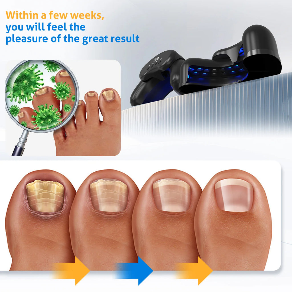 KTS Wireless Nail Laser Device – 30 Beads 470nm & 905nm Nail Laser Device Qst