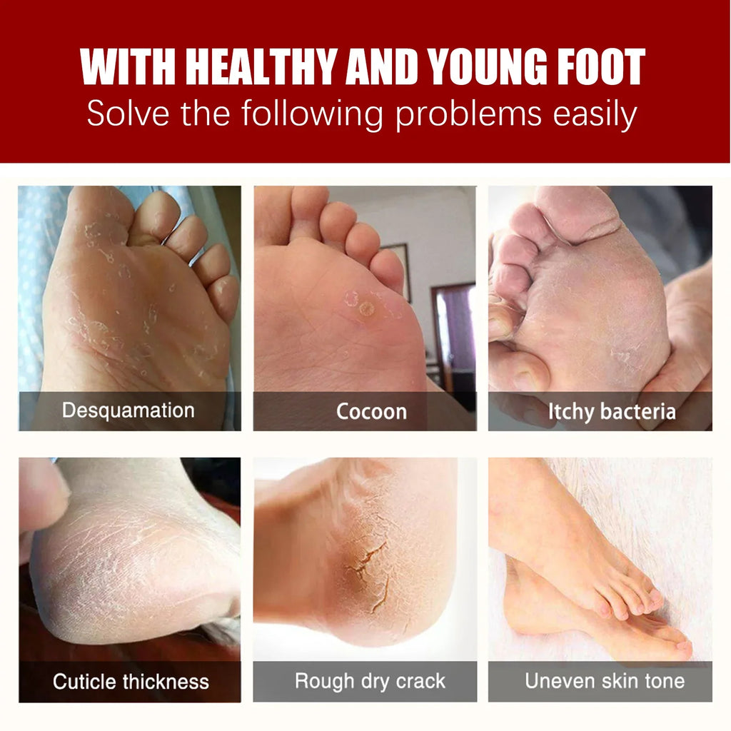 AHA Exfoliating Foot Mask – Moisturizing Heel & Callus Peel Exfoliating Foot Mask Qme