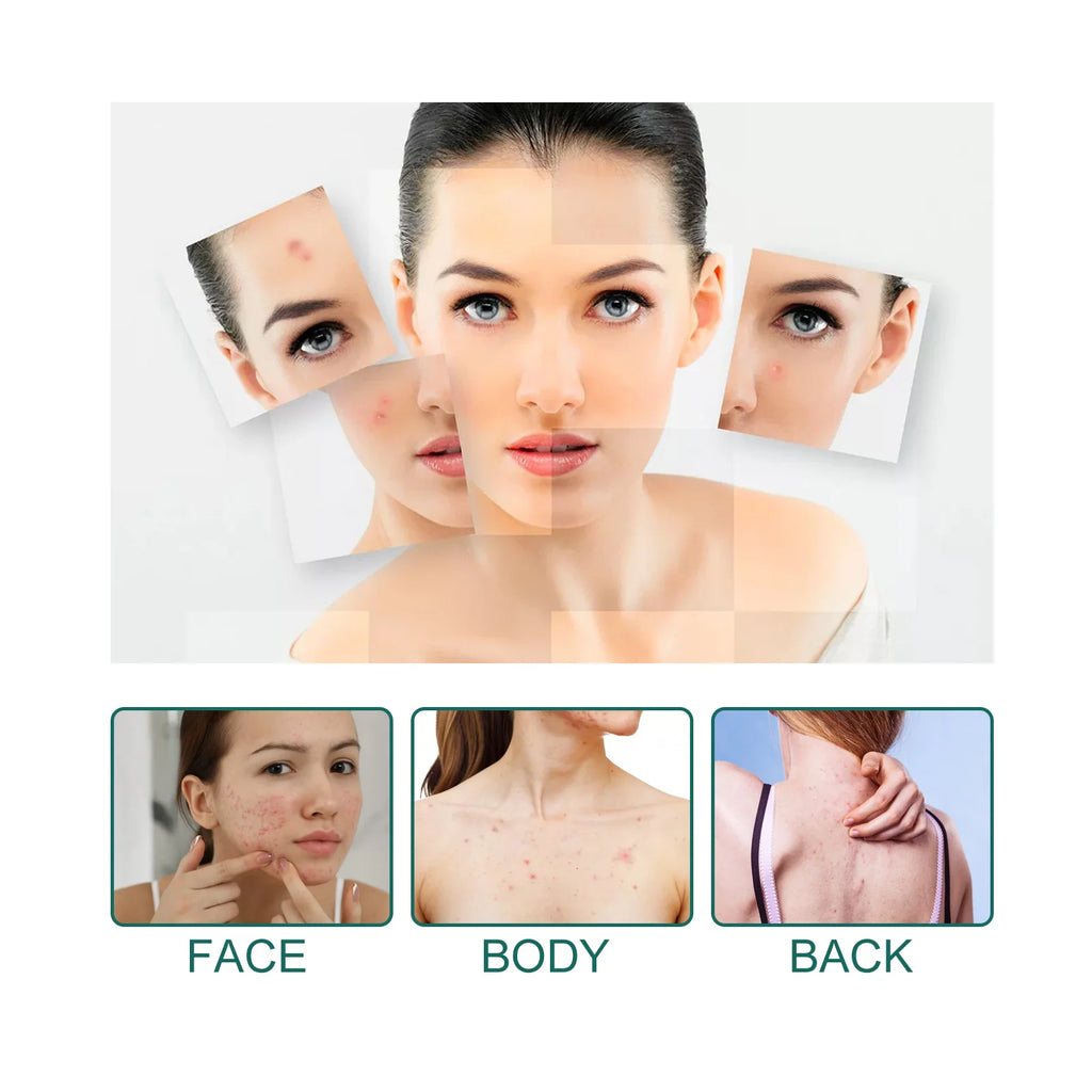 Star-Shaped Acne Pimple Patch – Gentle Blemish Care | Eelhoe Acne Pimple Patch Qst