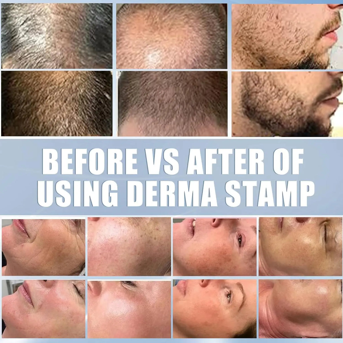 DRS 140A Adjustable Derma Stamp – 140 Pin Microneedling Tool Derma Stamp Qst
