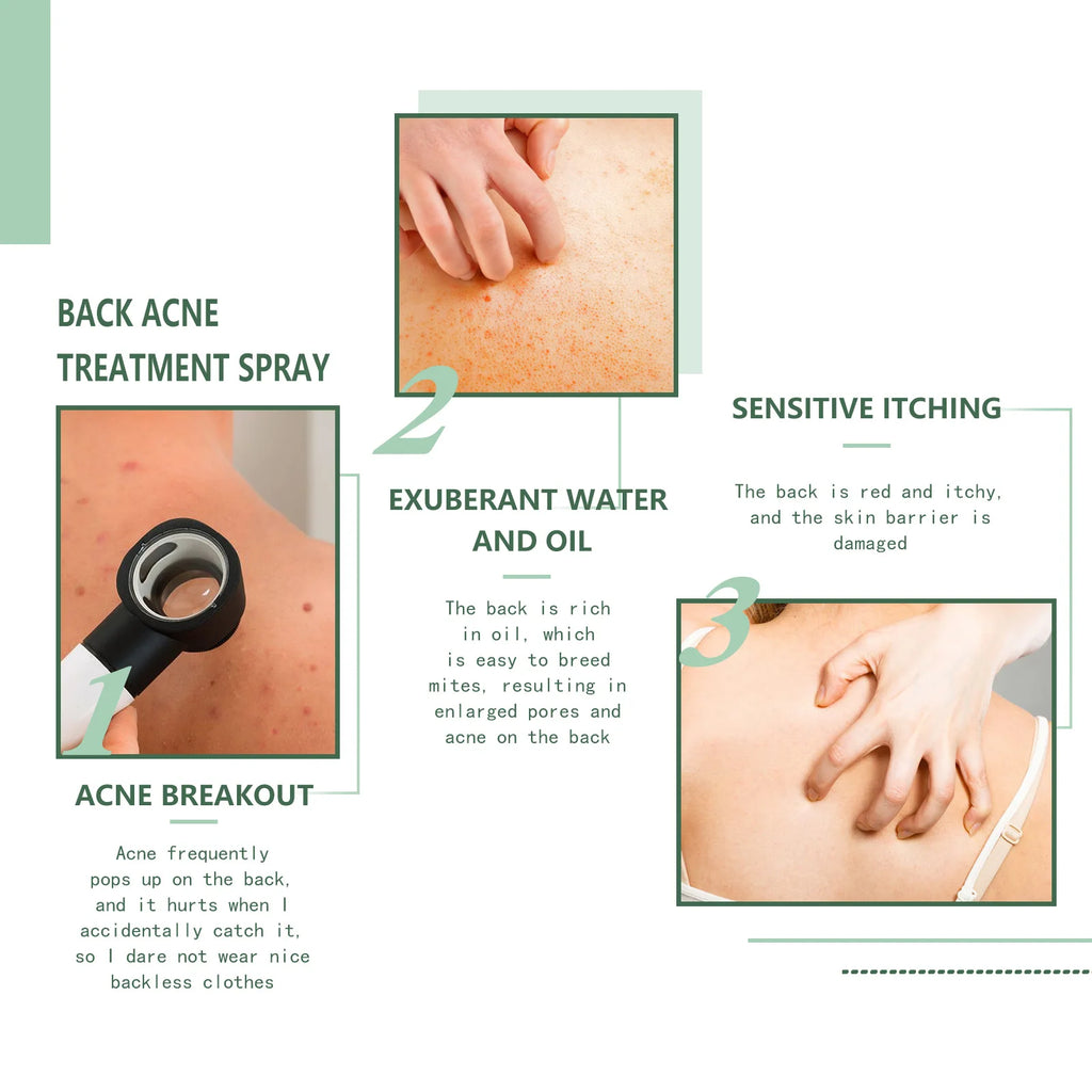 Eelhoe Back & Body Acne Clarifying Spray – 120ml Serum Body Acne Spray Qst